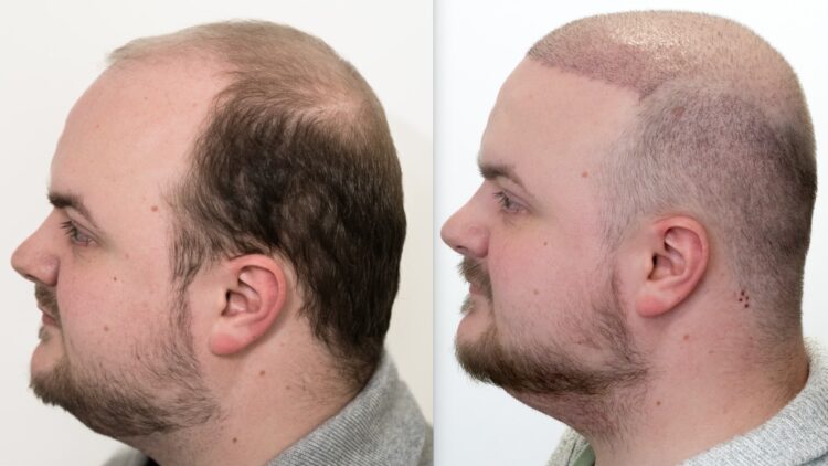 Implantul de par la clinica Dr. Felix Hair Implant – cea mai buna optiune
